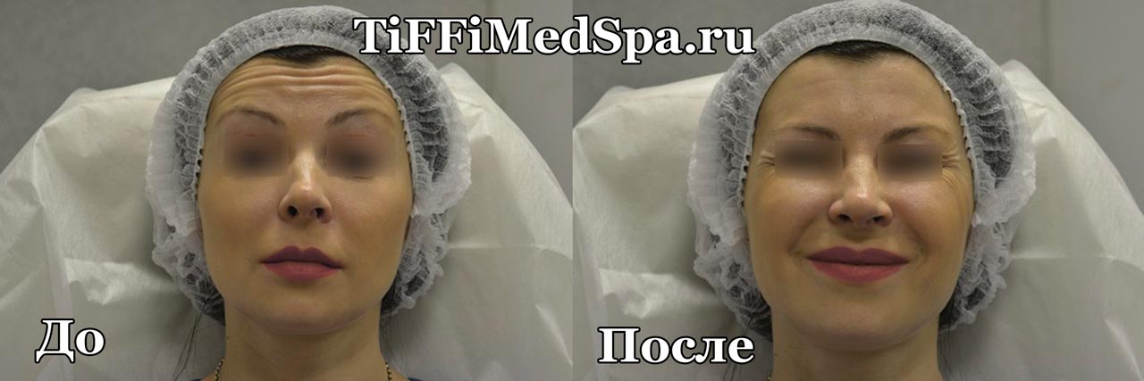 Ботокс До и После