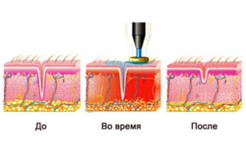 rf-lifting