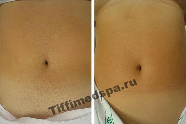 Фотоэпиляция на животе до и после