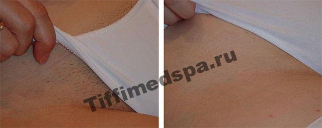 Фотоэпиляция зоны бикини до и после