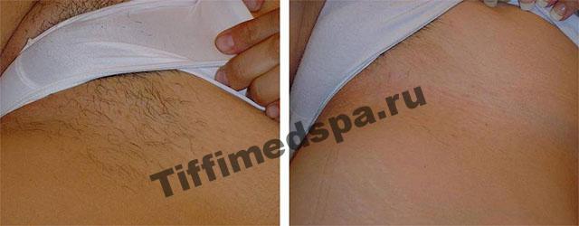 Фотоэпиляция зоны бикини до и после