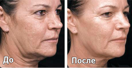melslom_tiffimedspa
