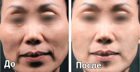 melslom_tiffimedspa