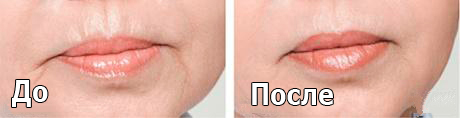 melslom_tiffimedspa
